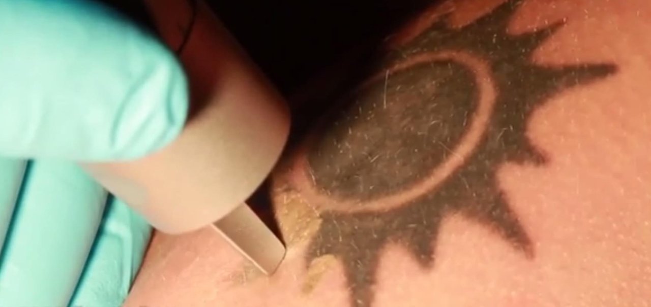 Veja em vídeo como funciona a remoção de tatuagens por laser