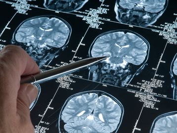Pesquisadores descobrem nova proteína responsável pelo Mal de Alzheimer