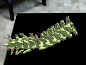 Orgulho nacional! Médicos brasileiros usam Hololens em cirurgia de coluna