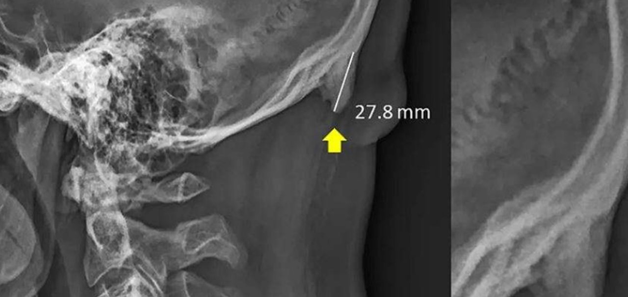 Uso de celular pode estar deformando seu crânio, dizem cientistas