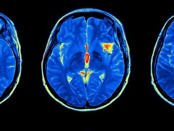 Inteligência artificial ajuda a identificar hemorragia cerebral