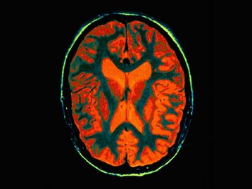 Por causa da microgravidade, cérebro se reorganiza no espaço