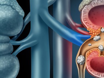Cientistas usam conhecimentos de geologia para tratar cálculos renais