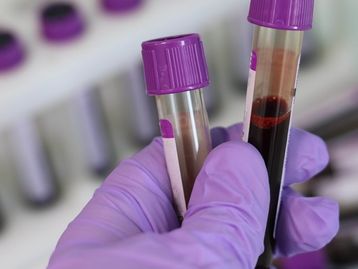 Cientistas encontram moléculas no sangue que indicam demência