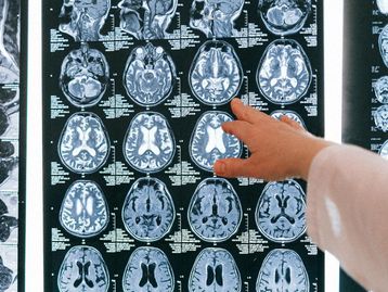 TOC: cientistas identificam sinais neurais ligados ao transtorno