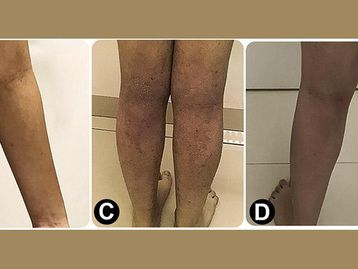 Dermatite atópica: vacina feita no Brasil reduz sintomas da doença