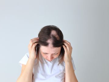 Alopecia: tratamento experimental faz cabelo crescer novamente 