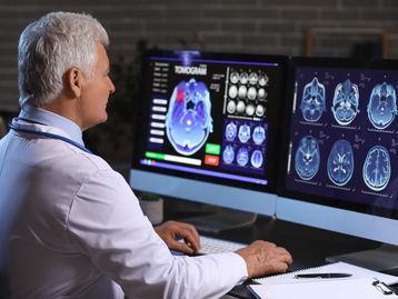 Pacientes com covid-19 têm mais risco de doenças neurodegenerativas