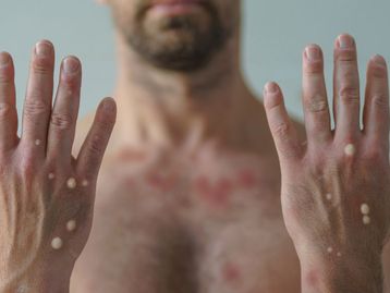 Varíola dos Macacos: como é o DNA do Monkeypox?