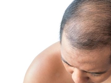 Comprimido de minoxidil evita queda de cabelo? Entenda seu novo uso