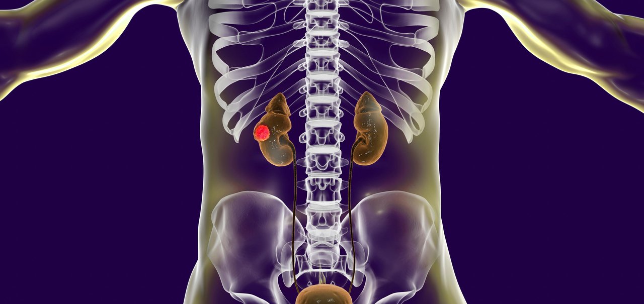 Câncer de Adrenal: conheça os sintomas e tratamento