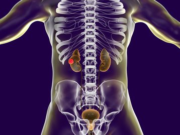 Câncer de Adrenal: conheça os sintomas e tratamento