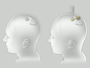 Elon Musk: Neuralink deve ser testado em humanos nos próximos meses