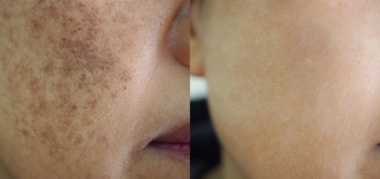 O que é melasma e como evitar o surgimento das manchas?