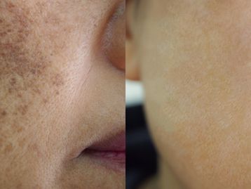 O que é melasma e como evitar o surgimento das manchas?