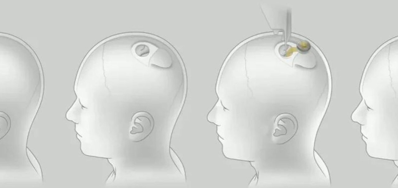 Neuralink: a empresa de Musk que criou um chip implantado no cérebro