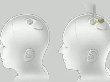 Neuralink: a empresa de Musk que criou um chip implantado no cérebro