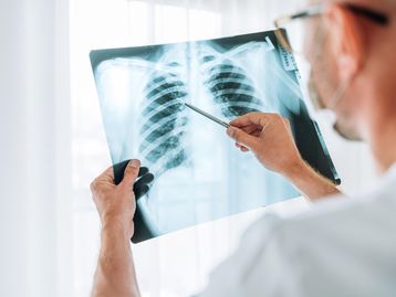 Inteligência artificial consegue prever risco de câncer de pulmão
