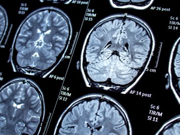 Atividade cerebral pode indicar tendência para o estresse pós-traumático