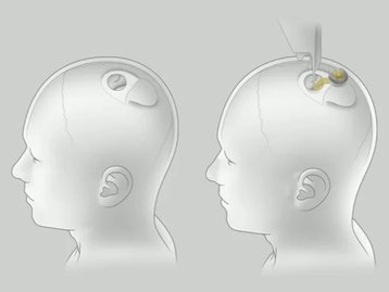 Neuralink de Elon Musk é investigada por transporte de patógenos perigosos