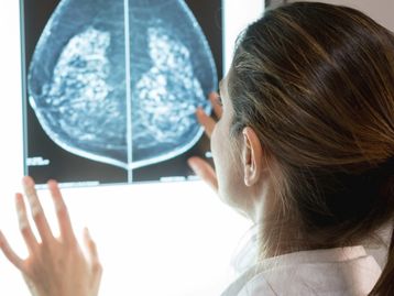 Inteligência artificial prevê eficácia de tratamento do câncer de mama
