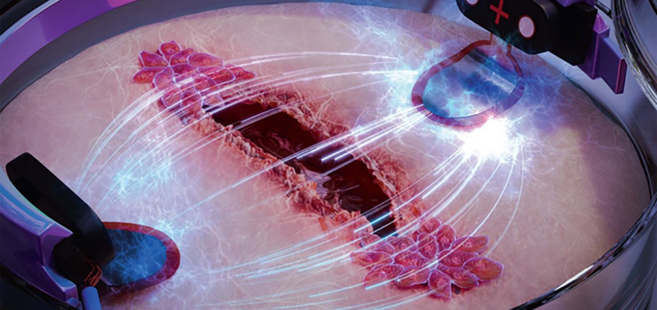 Estímulo elétrico acelera cicatrização de feridas crônicas