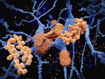 Novo teste pode indicar a progressão da Doença de Alzheimer