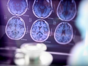 Homem é detectado com mutação genética rara que protege contra o Alzheimer