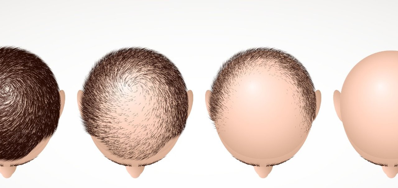 Estudo com bioimpressão 3D pode ser a solução contra a calvície