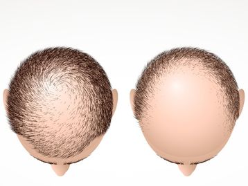 Estudo com bioimpressão 3D pode ser a solução contra a calvície