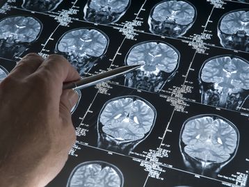 Neurocientista explica o que acontece no cérebro enquanto morremos