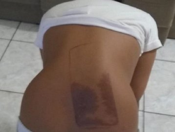 Criança dorme em cima de celular e sofre queimadura nas costas