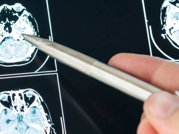 Vacina contra Alzheimer é aprovada em 2ª fase de testes em humanos