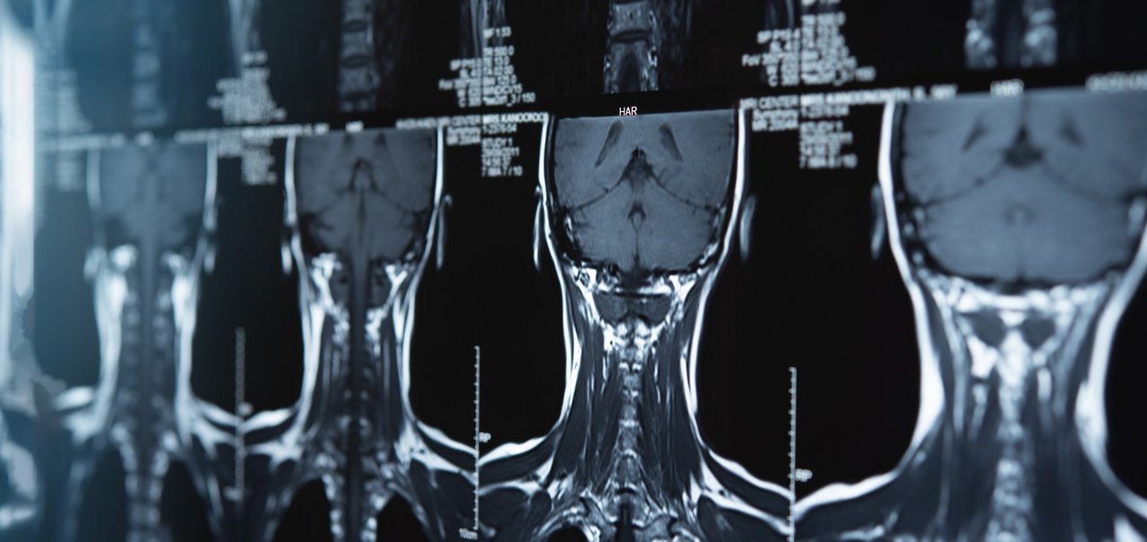 Método quântico é capaz de curar câncer cerebral por meio de spray; entenda