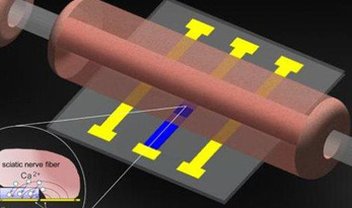 Nova técnica diminui a dor provocada por implantes cerebrais