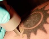 Veja em vídeo como funciona a remoção de tatuagens por laser