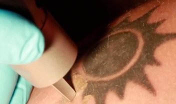 Veja em vídeo como funciona a remoção de tatuagens por laser