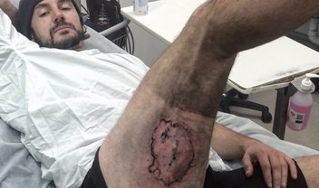 iPhone 6 explode e causa queimaduras em ciclista após queda de bicicleta