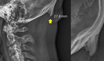 Uso de celular pode estar deformando seu crânio, dizem cientistas