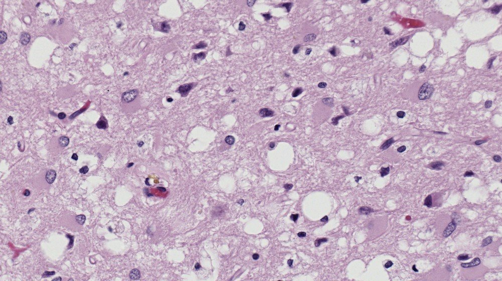 O tecido cerebral humano, visto sob microscópio, exibe os buracos esponjosos causados pela doença de Creutzfeldt-Jakob.