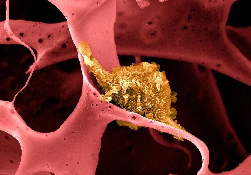 Os linfócitos (em amarelo) usam antígenos do tumor para desencadear uma resposta do sistema imunológico contra ele.