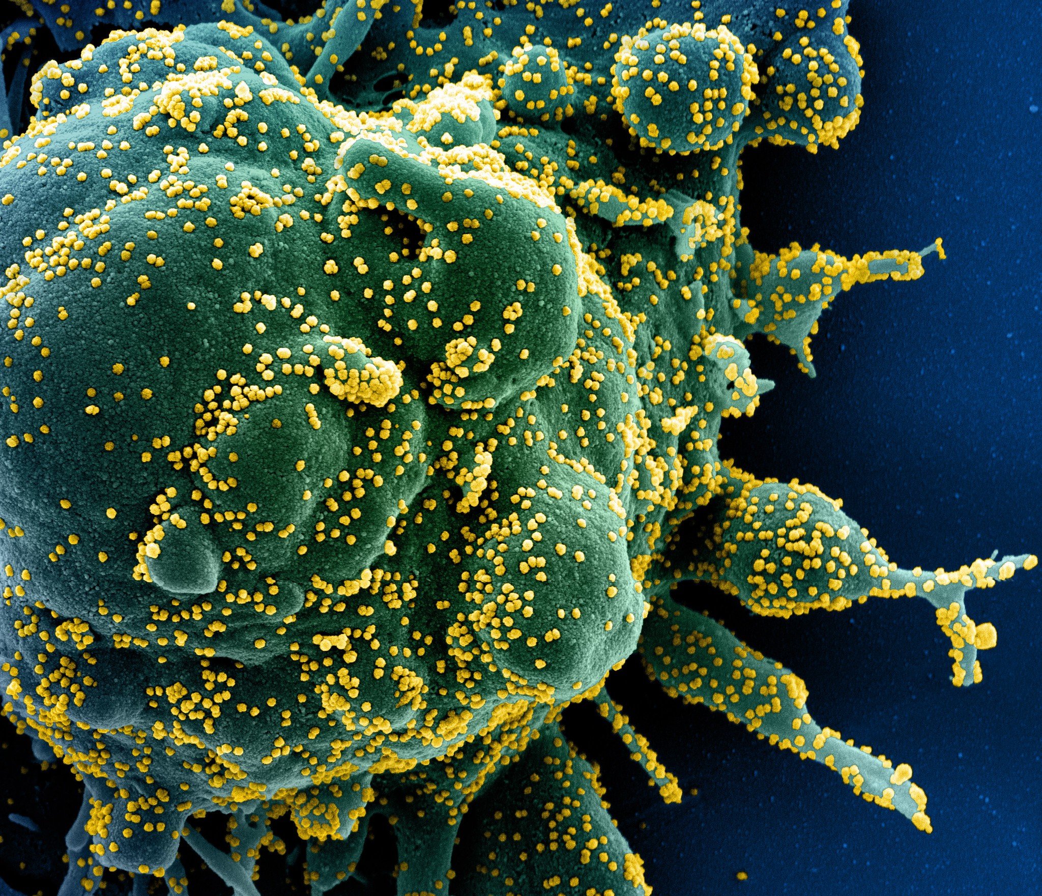 Células T identificam e destroem célula (verde) infectada pelo Sars-CoV-2 (amarelo)  (Fonte: NIAID/Reprodução)