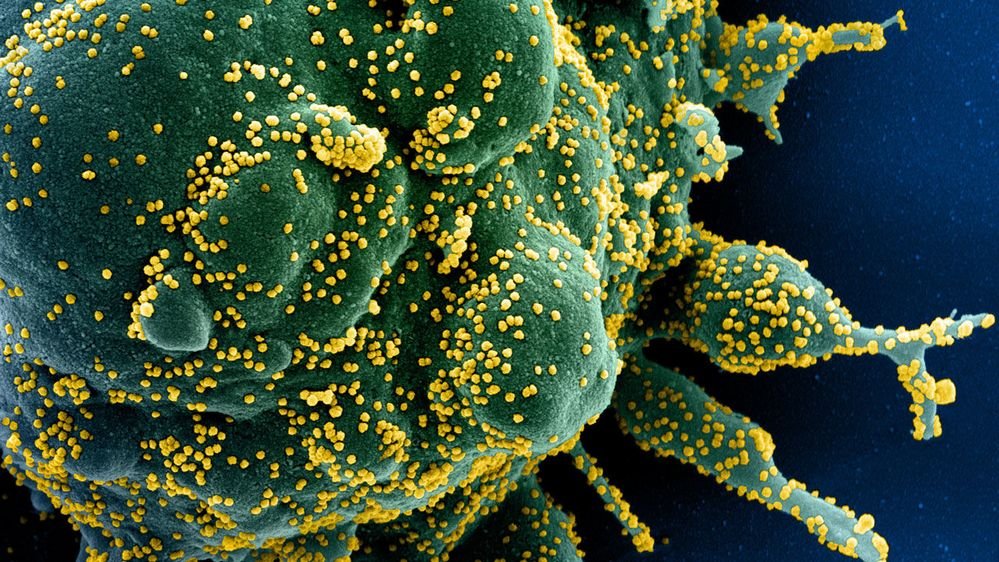 Uma célula (verde) é atacada pelo SARS-CoV-2 (amarelo).