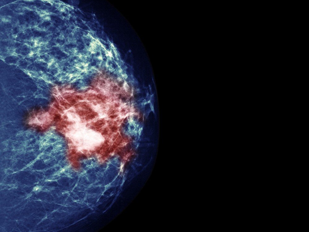 Uma das imunoterapias pesquisadas pela BioNTech é para o combate e prevenção da recidiva do câncer de mama triplo negativo, um dos tipos mais letais.