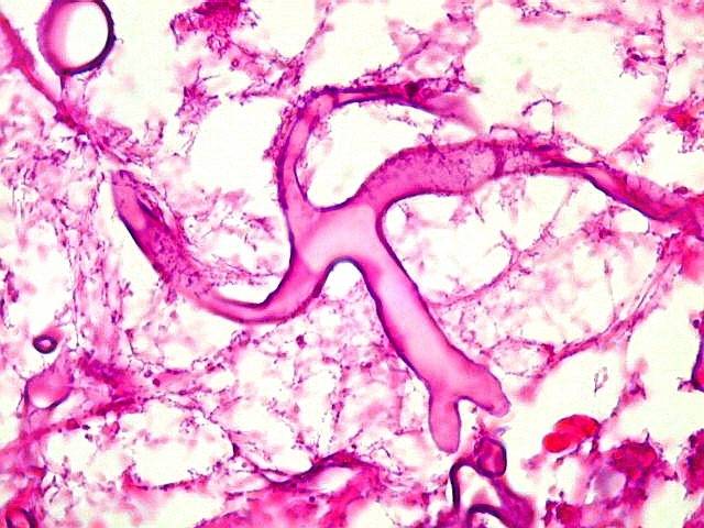 Imagem microscópica de célula atingida por fungo negro.