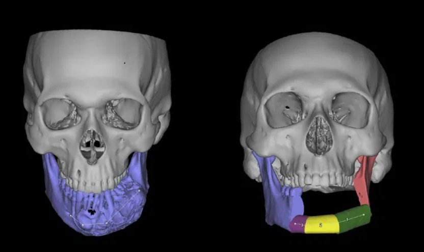 USP cria projeto que simula cirurgia craniana com impressão 3D e
