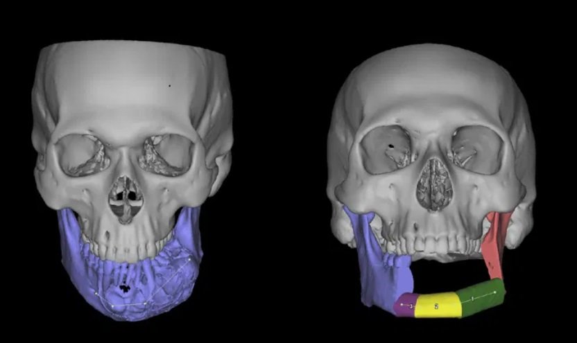 A cirurgia envolve a remoção de ossos da mandíbula e a substituição por um conjunto complexo de próteses que deve ser testada várias vezes antes do implante.