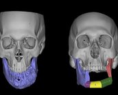 Hospital da USP faz cirurgia com ajuda de modelos impressos em 3D