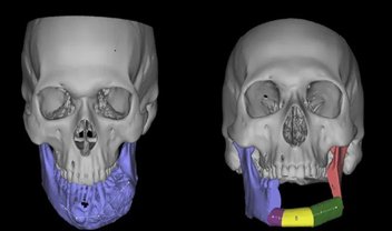 Hospital da USP faz cirurgia com ajuda de modelos impressos em 3D