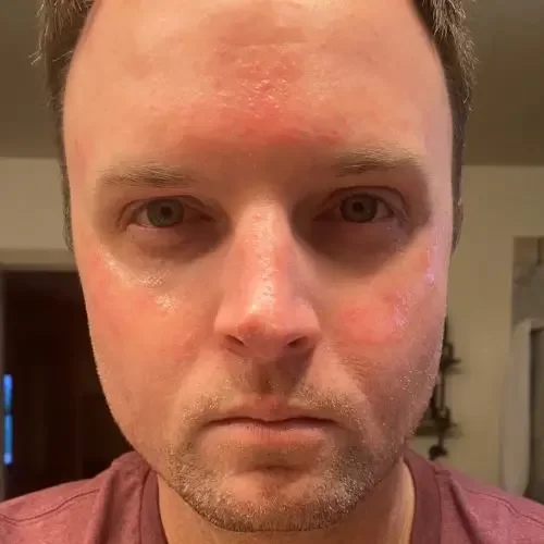 Rosto de um usuário que teve irritação de pele após o uso do headset.